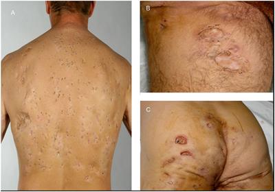 Generalized Comedones, Acne, and Hidradenitis Suppurativa in a Patient with an FGFR2 Missense Mutation